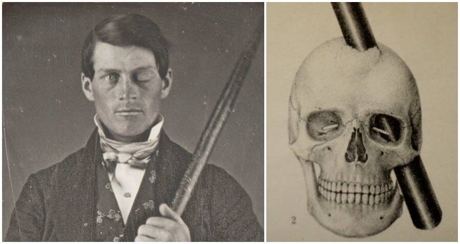 Caso de Phineas Gage e ilustração do acidente